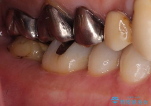【フルジルコニアクラウン】他院で治療したクラウンが外れたの治療前