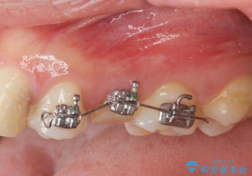 挺出小矯正を行った縁下カリエス治療