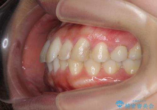 挺出小矯正を行った縁下カリエス治療の治療前