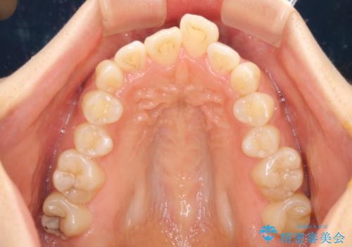 カリエールディスタライザーを併用した、咬み合わせ改善のインビザライン矯正の治療前