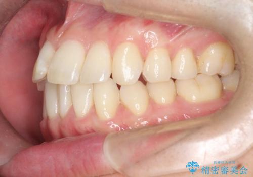 前歯の重なりとガタガタをマウスピースで改善した症例の治療前