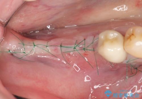 骨の造成を同時に行うインプラント治療の治療前