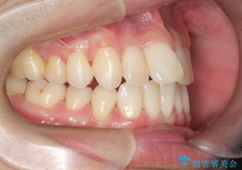 前歯の重なりとガタガタをマウスピースで改善した症例の治療前