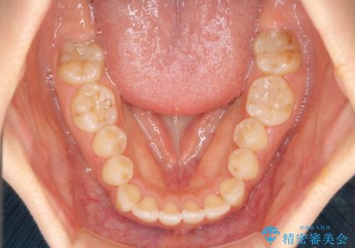 カリエールディスタライザーを併用した、咬み合わせ改善のインビザライン矯正の治療前