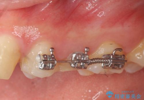 挺出小矯正を行った縁下カリエス治療の治療前