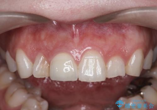 前歯の変色 セラミッククラウンによる審美性の回復の治療後