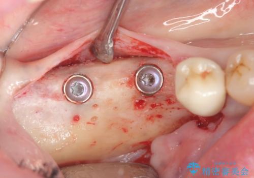 骨の造成を同時に行うインプラント治療の治療前