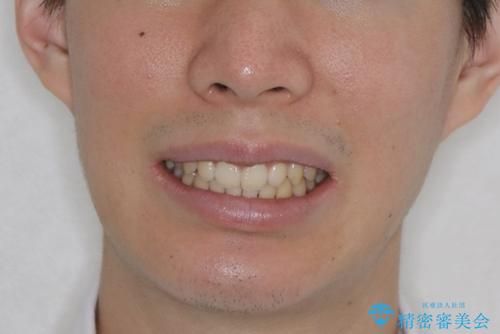 前歯が見えすぎる:インビザラインFULLで奥歯の噛み合わせも改善の治療後（顔貌）