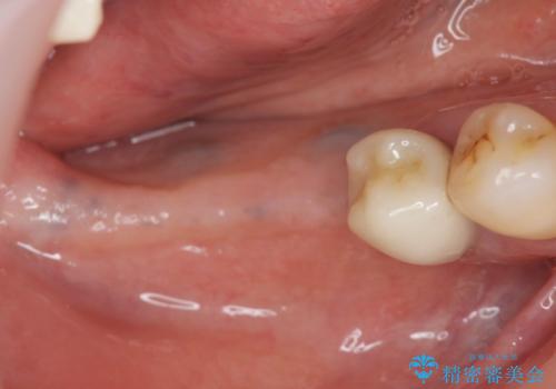 骨の造成を同時に行うインプラント治療の治療中