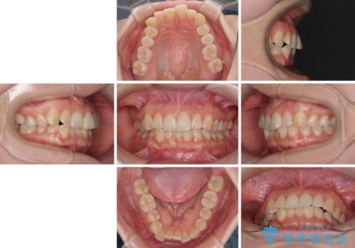 【モニター】前歯のデコボコを目立たないワイヤー装置で短期間矯正治療の治療前