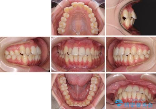 【モニター】前歯の前突感とクロスバイトをインビザラインで改善の治療前