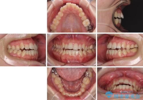 オープンバイトと前歯のデコボコをインビザライン矯正で解消の治療前