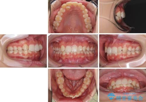 インビザラインが続けられない ワイヤー矯正での抜歯矯正 その2の治療前