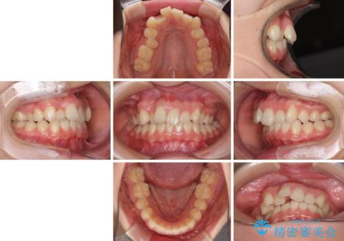 上顎のみの抜歯矯正 前歯のデコボコを改善するの治療前