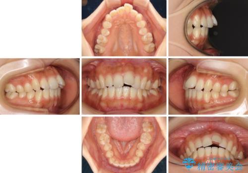 カリエールディスタライザーを併用した、咬み合わせ改善のインビザライン矯正の治療前