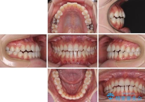 舌突出癖で口元が開いてしまう 舌トレーニングを行ったインビザライン矯正の治療前