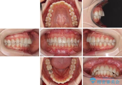 前歯の突出感とデコボコをインビザライン矯正で改善の治療前