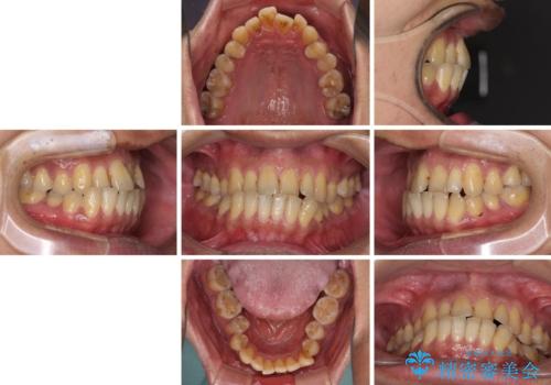 前歯のクロスバイトを改善 ワイヤー装置での非抜歯矯正の治療前