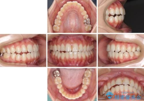 オープンバイトによる見た目を治したい インビザラインでの矯正治療の治療前
