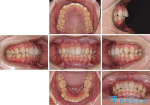 【モニター】ワイヤー矯正で手っ取り早く治療の治療前