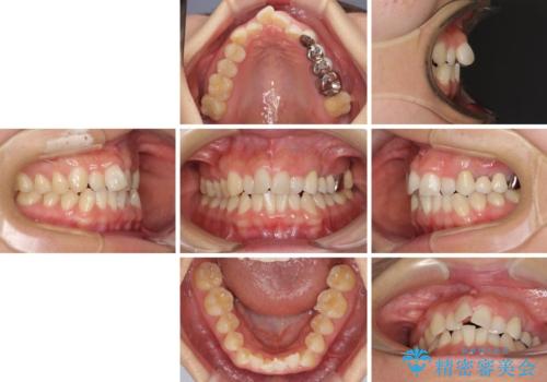 捻れた前歯と銀歯のブリッジを治したい ワイヤー矯正とオールセラミックブリッジの治療前
