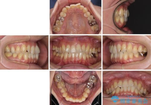 リスク回避 ワイヤー矯正を併用したインビザライン矯正治療の治療前