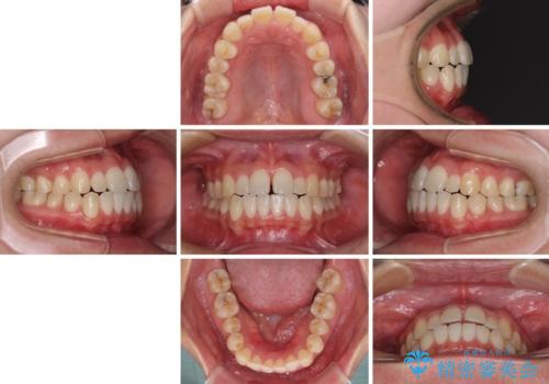 すきっ歯とオープンバイトをインビザラインで改善の治療前