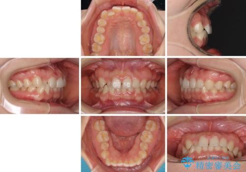 【モニター】前歯の歯列不正をワイヤー装置で短期間矯正治療の治療前