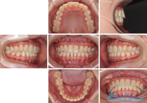 前歯の隙間と上下正中のズレを解消の治療前
