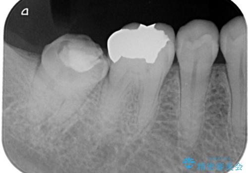 【フルジルコニアクラウン】他院で治療したクラウンが外れたの治療前