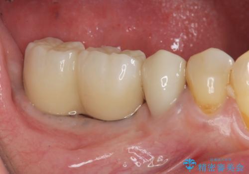 骨の造成を同時に行うインプラント治療の治療後