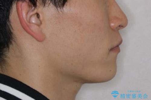 すきっ歯が気になる:見た目も噛み合わせもインビザラインでまとめて治すの治療後(顔貌)