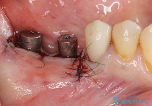 骨の造成を同時に行うインプラント治療の治療中