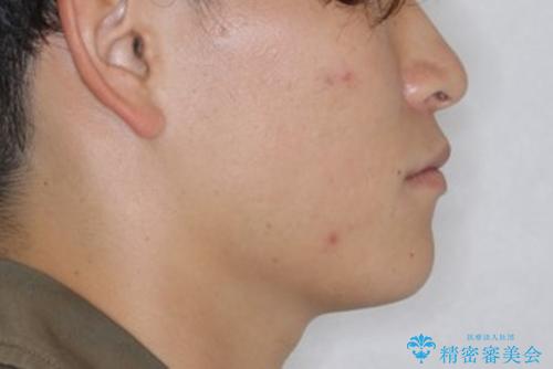 すきっ歯が気になる:見た目も噛み合わせもインビザラインでまとめて治すの治療前(顔貌)