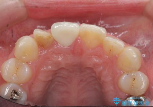 前歯の変色 セラミッククラウンによる審美性の回復の治療後