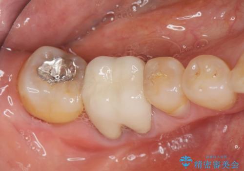 分岐部 Ⅲ 度病変による抜歯　小矯正後のブリッジ治療の治療前