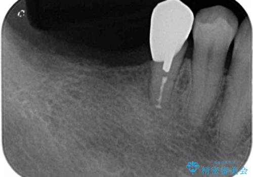 骨の造成を同時に行うインプラント治療の治療前