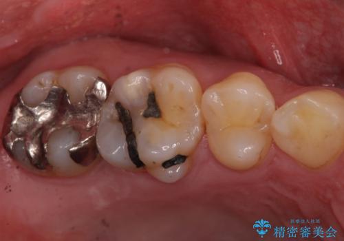 昔治療した銀歯を綺麗なセラミックに変えたい セラミックインレーの治療前