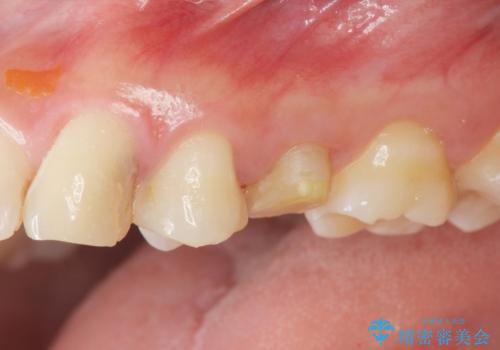 挺出小矯正を行った縁下カリエス治療の症例 治療前