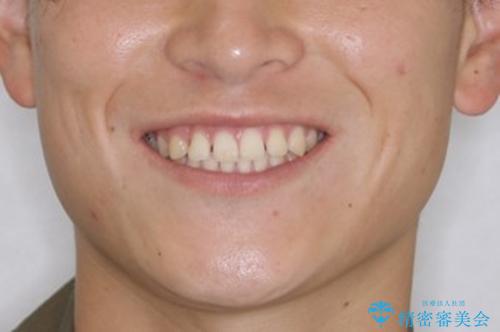 すきっ歯が気になる:見た目も噛み合わせもインビザラインでまとめて治すの治療前(顔貌)