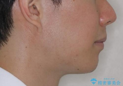 前歯が見えすぎる:インビザラインFULLで奥歯の噛み合わせも改善の治療後(顔貌)