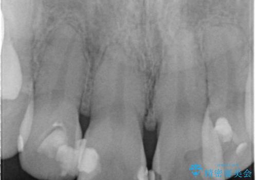 前歯2本の着色が気になる、、、セラミック治療の治療前