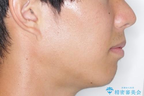 前歯が見えすぎる:インビザラインFULLで奥歯の噛み合わせも改善の治療前(顔貌)