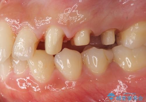 挺出小矯正を行った縁下カリエス治療の治療中