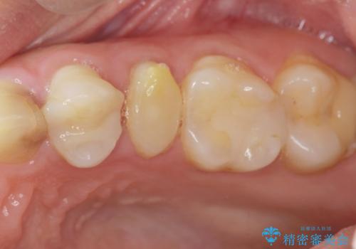 挺出小矯正を行った縁下カリエス治療の治療前