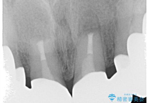【オールセラミッククラウン】前歯を綺麗にしたい。の治療後