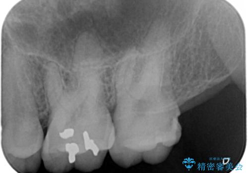 ものが詰まるから、治療してほしい セラミック治療の治療前
