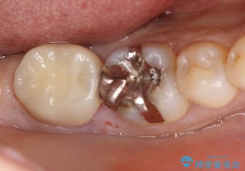 【フルジルコニアクラウン】他院で治療したクラウンが外れたの治療後