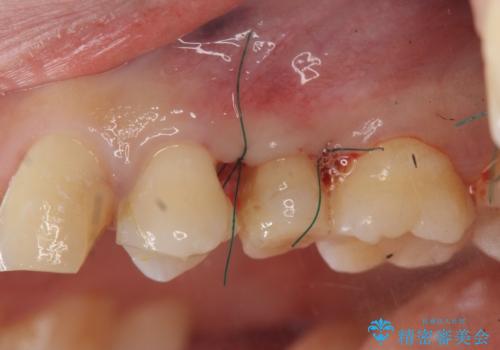 挺出小矯正を行った縁下カリエス治療の治療中