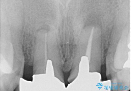 【オールセラミッククラウン】前歯を綺麗にしたい。の治療前